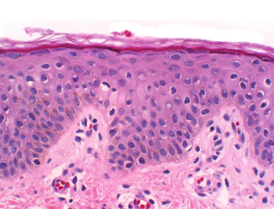 피부과학_dermatology 표피 Epidermis 각질층 과립층 표피는 지속적으로 새롭게 생성되는 피부구조물로, 두 께는 0.4~1.5 mm이며 각질형성세포, 멜라닌세포, 랑게 가시층 르한스세포 및 머켈세포로 구성된다. 1.