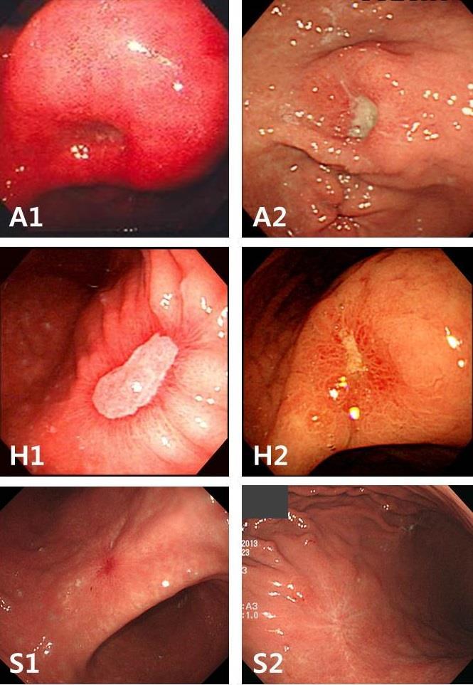 4) Ulcer 를기술하는방법
