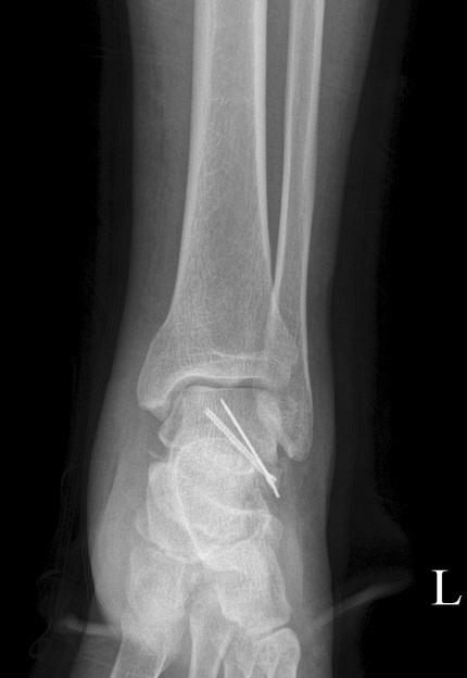 Peroneus Tendon Dislocation Associated with Fracture of Lateral Process of Talus 225 Fig. 5. Postoperative anteroposterior and lateral radiograph.