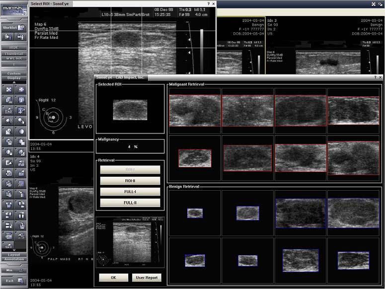 Integration : CAD (Computer Aided Diagnosis) Mammography 에서주로사용하는기능 Detection 기능을주로사용하며최근에 US CAD 기능이들어간 Diagnosis