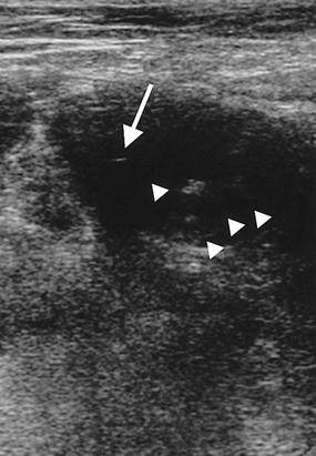 - 황기원외 6 인 : 가성동맥류를트롬빈주입으로치료한 1 예 - Figure 3. On 29th days of thrombin injection, a three dimensional reconstruction of the MR angiogram shows a normal common iliac artery bilaterally. A B Figure 2.