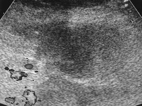 (A) Gray-scale ultrasound of the pseudoaneurysm shows the tip of the needle (arrow) positioned within the superficial aspect of the lumen and the echogenic thrombi (arrowheads) (B) Color Doppler