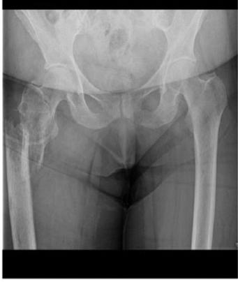 III. Complication Pathologic Fracture 9-29% of patients with bone metastasis Fractures have been associated with