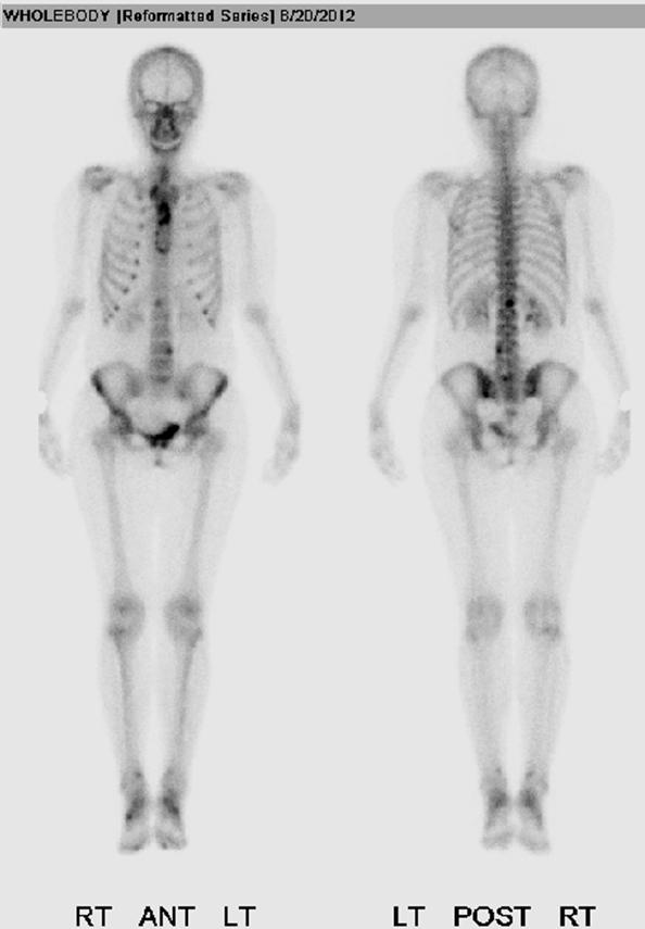 IV. Imaging modality Skeletal Scintigraphy (Bone scan) Most common modality for Detecting bone metastasis Uses of Radiopharmaceuticals reflects bone metabolism Appearance ; Hot spot Sensitivity ;