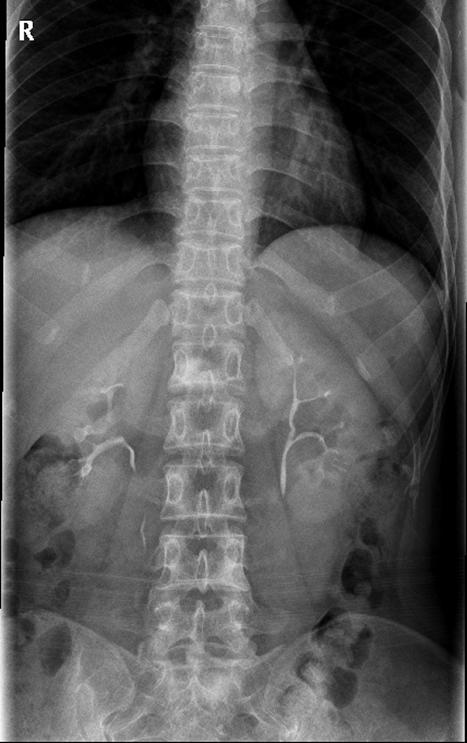 IV. Imaging modality X-ray Appearance Osteolytic lesion ; Faint or