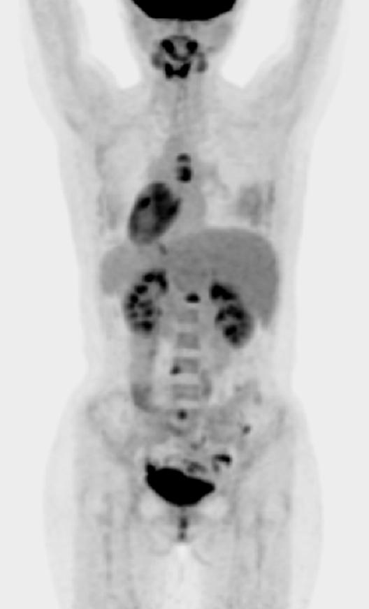 IV. Imaging modality PET (Positron Emission Tomography) Appearance ; Hot spot