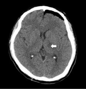 The arrow indicates the nucleus ventralis intermedius of the left thalamus with a permanent radiofrequency thermolesion. nolol 과 primidone 이다.