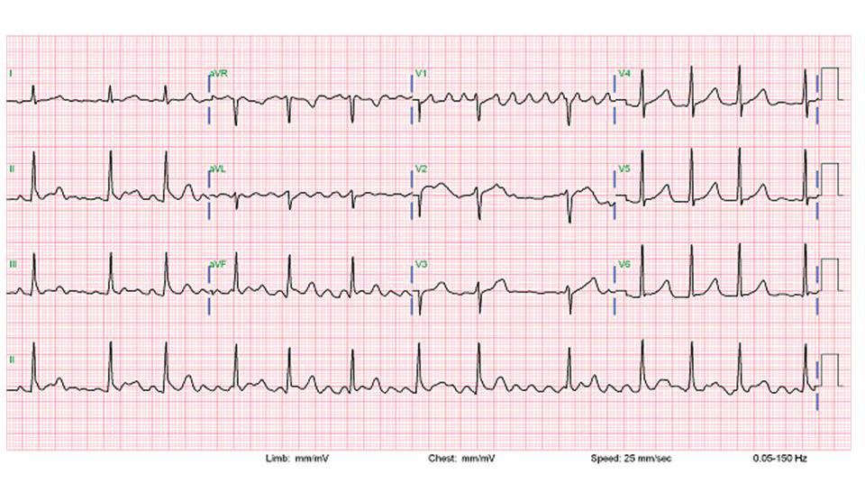 MAIN TOPIC REVIEWS Figure 1. Twenty six old lady complained of palpitation, dizziness and presyncope. The electrocardiogram shows irregular heart rhythm and rapid heart beats.