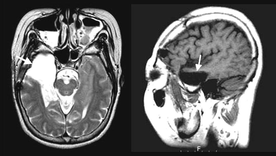 Anterior temporal lobectomy with amygdalohippocampectomy. 45 year old woman had complex partial seizures arising from right mesial temporal region.