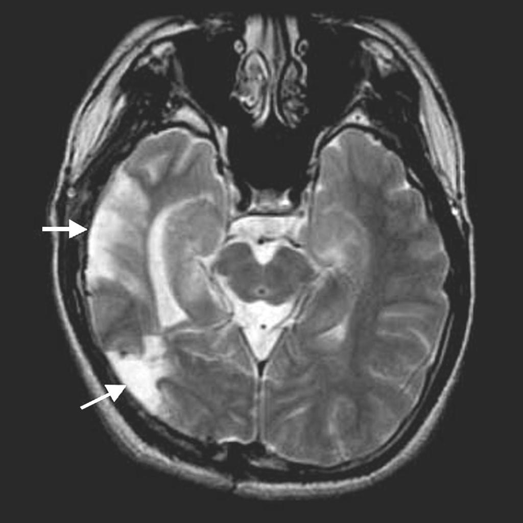 Multilobar resection. Twenty six year old man has suffered from complex partial seizures and nocturnal generalized tonic clonic seizures since his age 14.