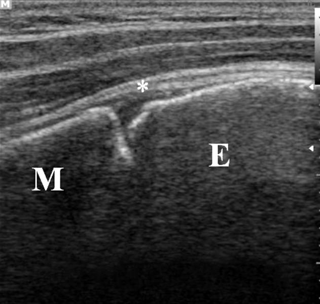 (C) Longitudinal images of both shoulders show hyperechoic irregular growth plate with bony fragmentation and widening of proximal humeral growth plate (asterisks indicate