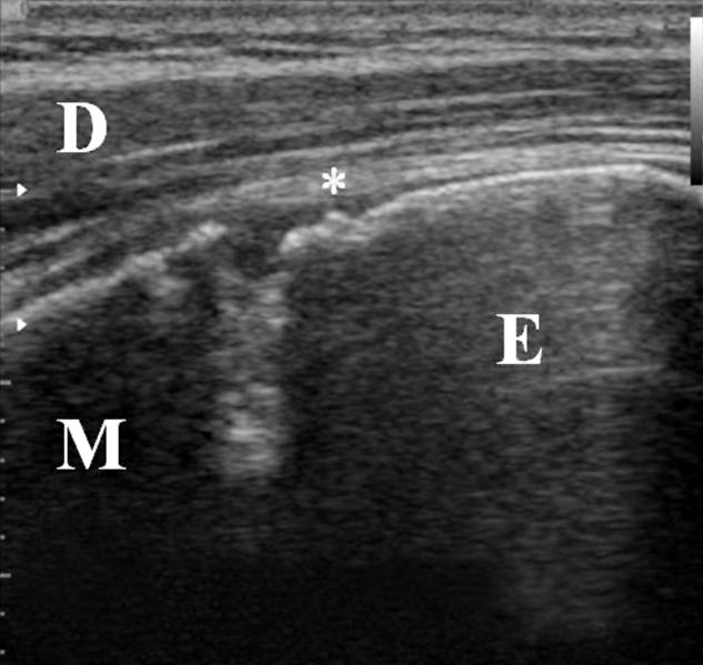 Bilateral measurement of physeal gap in right little leaguer shoulder player. Increased physeal gap (d1 d2=1.9 mm) is noted as right throwing side and nonthrowing side, 3.