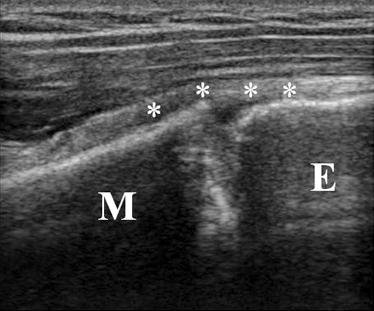 M: proximal humeral metaphysis, E: proximal humeral epiphysis. Fig. 4.
