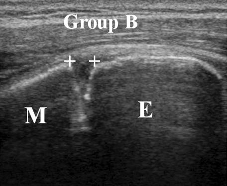 M: proximal humeral metaphysis, E: proximal humeral epiphysis. Table 3.