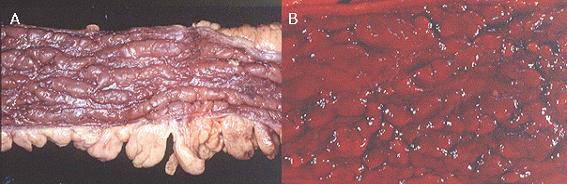 Tuberculosis and Respiratory Diseases Vol. 61. No.4, Oct. 2006 Figure 1. Surgical specimen of intestine.