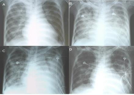 SM Park et al: A Case of Goodpsture Syndrome combined with Crohn Disease Figure 3. Serial follow up of chest X-ray. A: At admission, diffuse hazy infiltration was noted on right lung field.