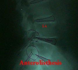 요추분석 Anterolisthesis 일반적으로척추의추체가전방으로하나이상