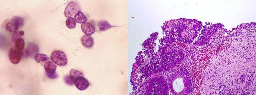 8 대한세포병리학회지 / 제 17 권 / 제 1 호 / 2006 Fig. 5. Carcinoma in situ in cathetherized urine. () Epithelial cells of naked nuclei are scattered in clean background.