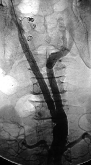 The 72 years old male had endoluminal stent-graft insertion for fusiform aortic aneurysm extended to right