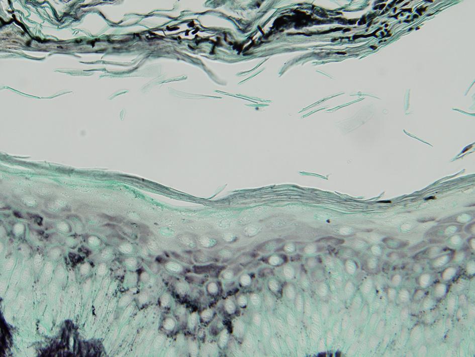 Several long hyphae in stratum corneum (GMS stain, 400). 신기능 검사와 매독혈청반응 검사, 흉부 X-선 검 사, 심전도 검사는 모두 정상 범위 내지 음성이 간 배양한 결과 배지에 전면에는 희고 미세한 섬 었다.