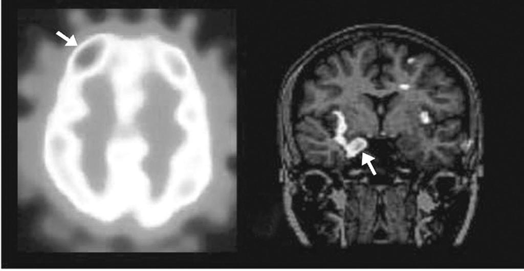 A 69 B Ictal SPECT and SISCOM. Ictal SPECT (A) shows increased cerebral blood flow on right anterior frontal region (arrow).