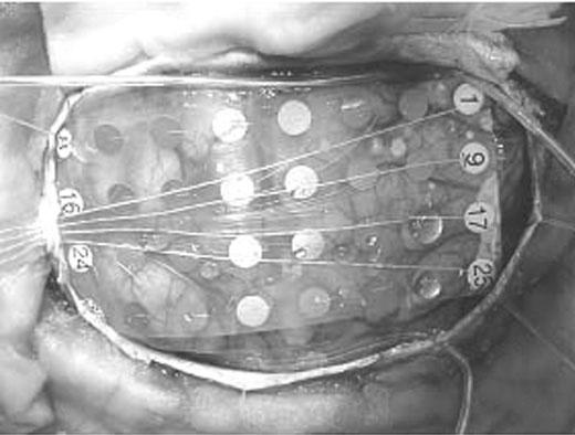 A B C Intracranial electrodes.