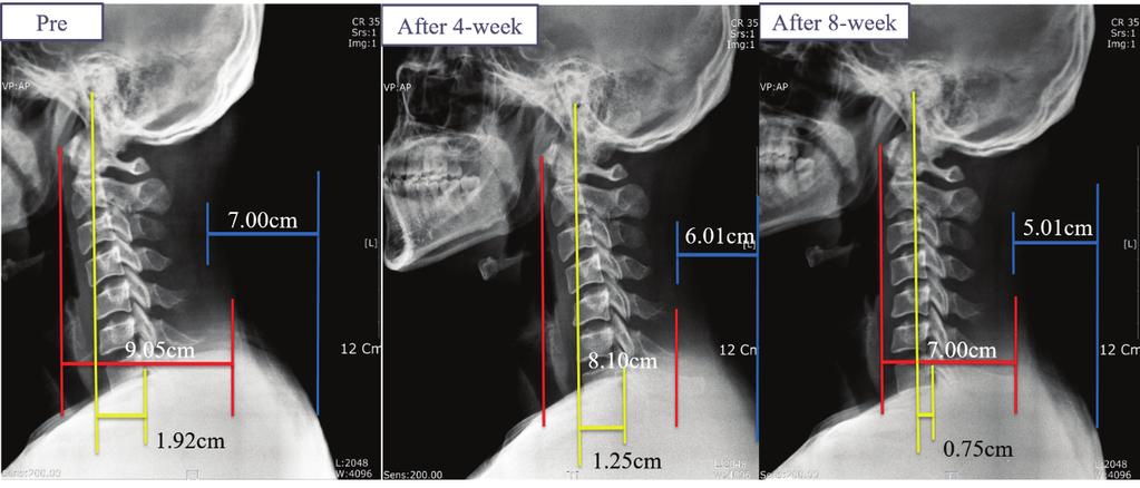 Fig. 3. Lateral view of cervical spine pre, after 4- and 8-week therapeutic exercise in a patient A 기때문이라고보고하였다 (O Leary et al., 2003). 이사례연구에서 VAS 및 NDI는환자 A와 B 모두에서운동전과비교하여운동 8주후에각각감소하는것으로나타났다.