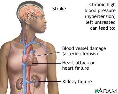 Untreated hypertension can result in: Arteriosclerosis