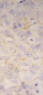 (C) 2+: Week positive; A weak to moderate complete membrane staining is observed in >10% of tumor cells.