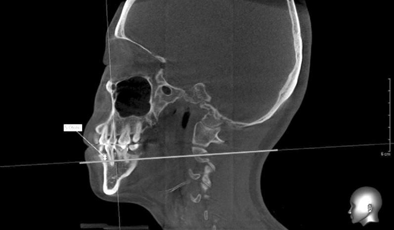 한국인연령에따른하악치조골골밀도 골변화를민감하게반영하지못해골밀도를추정하는데어려움이있다. 또한비교적정확한골밀도측정이가능한 CT를이용하는방법은대부분의연구들이주로백인과흑인만을대상으로해왔고아시아권에서는별로연구된바가없었다.
