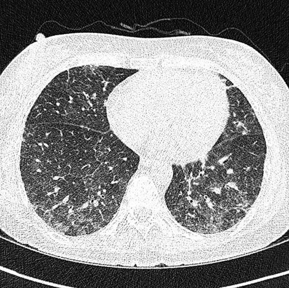 J Korean Soc Transplant ㆍ December 2015 ㆍ Volume 29 ㆍ Issue 4 Fig. 2. (A) High resolution computed tomography (HRCT) on admission shows diffuse ground glass opacity (GGO) of lower lung predominance.
