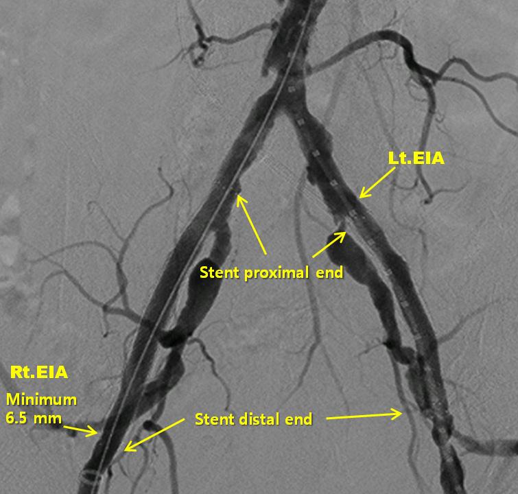 (B) Balloon angioplasty was performed with an 8 40 mm balloon. (C) Angiography after balloon angioplasty. (D) An 18 Fr sheath was advanced through the previous stented segment.
