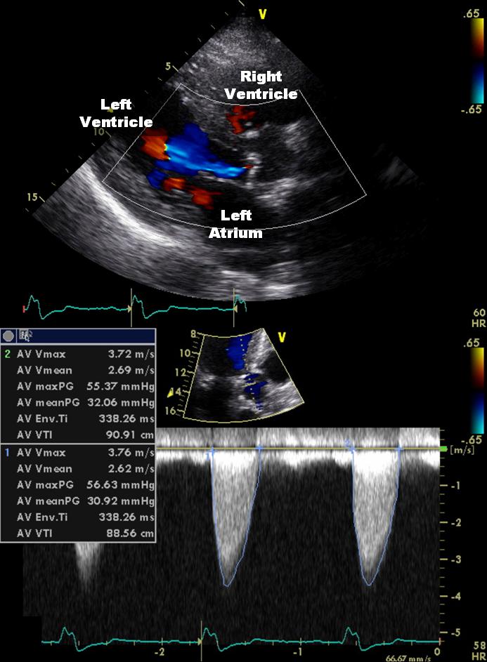 aortic valve and spontaneously expanded.