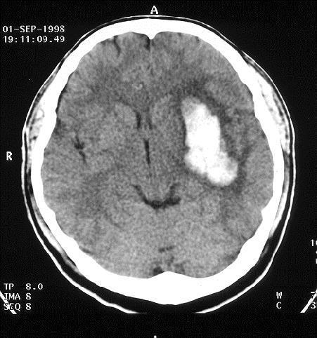 뇌출혈진단 CT