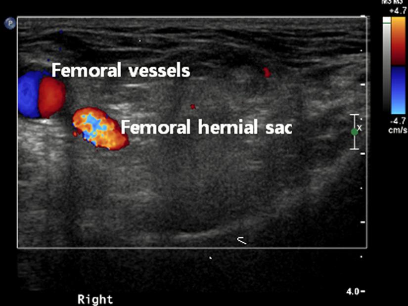 Jin Hee Paik, et al:totally Extraperitoneal (TEP) Approach for Femoral Hernia 395 Table 1.