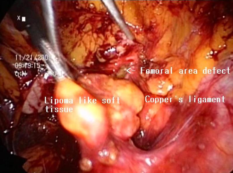 Jin Hee Paik, et al:totally Extraperitoneal (TEP) Approach for Femoral Hernia 397 Fig. 4. Laparoscopic view of right femoral hernia. The lipoma-like mass observed in femoral area defect.
