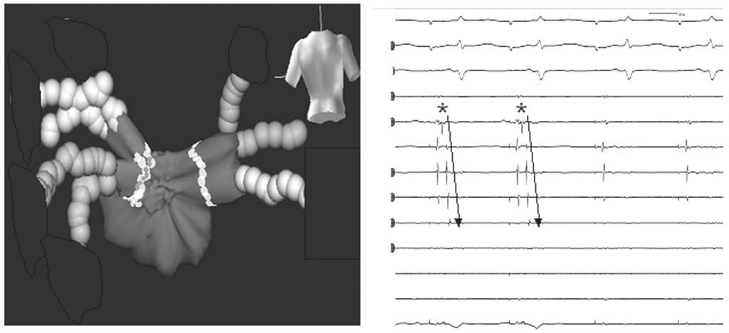 Kim YH A B A) 3 Dimensional Mapping System Guided Circumferential Pulmonary Vein Ablation B) Elimination of PVPs by Additional Ablation at the LA PVJunction Showing PVPs After encircling of pulmonary