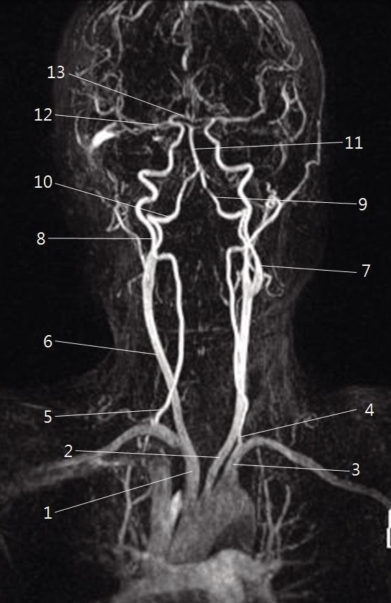 Journal of Neurosonology Vol. 2, No. 1, 2010 1.1. 총경동맥 (common carotid artery, CCA) 우측 CCA 는대동맥궁에서기시한팔머리동맥 (brachiocephalic artery) 으로부터분지하며, 좌측 CCA는직접대동맥궁에서기시한다. 따라서좌측 CCA의길이가우측보다 4~5 cm 가량길다. 1.2. 내경동맥 (internal carotid artery, ICA) CCA의가장큰분지인 ICA는설골 (hyoid bone) 과갑상연골 (thyroid cartilage) 의위경계정도의높이에서 CCA에서뒤외측방향으로분지후머리쪽으로주행하며 2~3 cm 가량의경동맥팽대를형성한다.