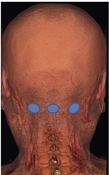 TH Park. Neurovascular Anatomy and Transcranial Doppler Technique Fig. 4. Suboccipital window. 찾도록하며탐침자를향하는혈류방향의 C4와멀어지는방향의 C2 혈류를확인하도록한다. 2.3.