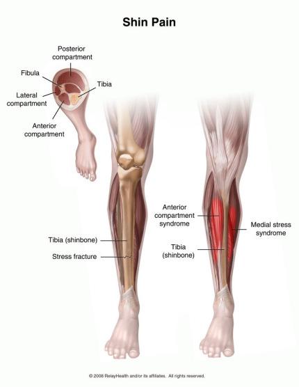 곧게선대한민국 정강이통증(shin pain 을위한운동법 2 1. 정강이통증 (shin pain 은무엇인가? 정강이통증은발목위와무릎아래의아랫다리앞쪽에나타나는통증입니다.