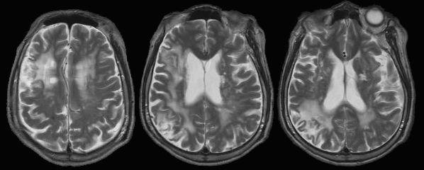 Multi-infarct Dementia: MID Multiple large complete infarcts Cortical or