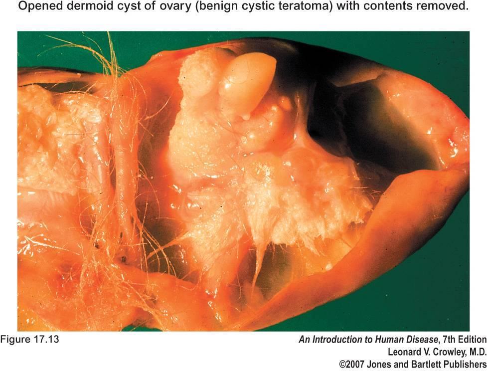 Benign cystic teratoma (dermoid cyst) Arise from unfertilized