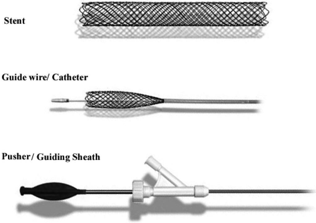 담관 협착 치료를 위한 스텐트 삽입술 Figure 1. Self-expandable metallic nitinol stent on top of a barrel shaped stainless steel zig (A). The stent removed from the zig after heat treatment at 500oC (B).