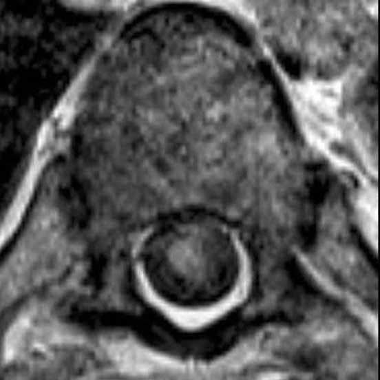 MR images from outside clinic show severe nodular hyperintense lesion (arrow) within thoracic spinal cord on T2-weighted image (a) at the level between T5 and T7 vertebrae, which is isointense to
