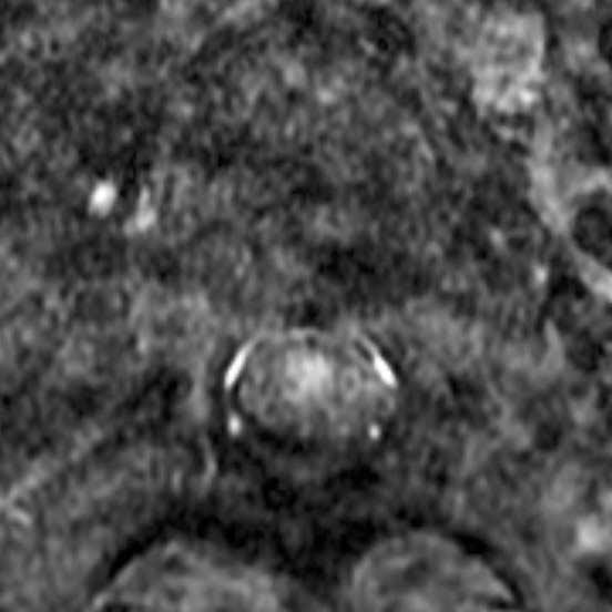 Intramedullary lesion (arrow) is again noted with similar extent on T2-weighted image (a) and enhanced T1-weighted image (c)