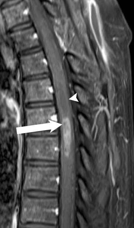 Follow-up MR imaging shows interval increase in size of syringomyelia (arrowhead) and intratumoral cyst (arrow)