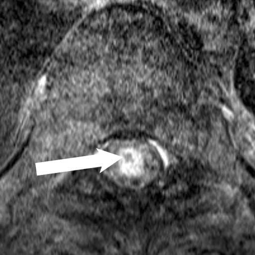 Intratumoral cyst is now seen as well-defined low signal intensity on T1 (b)- weighted image without enhancement.