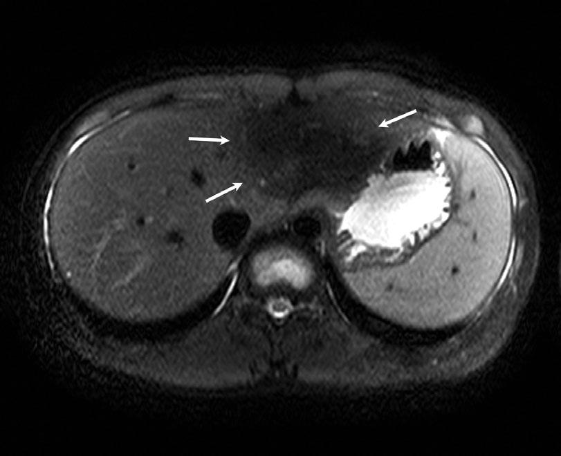 xial T2*-weighted brain perfusion magnetic resonance (MR) images (repetition time msec/echo time msec, 1,779.2/40.0; flip angle, 90 ) at 3 tesla.