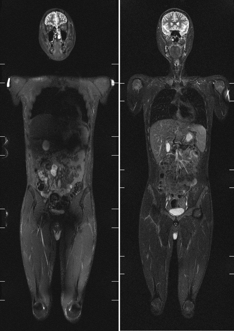 Goo HW Figure 10. Whole-body magnetic resonance imaging. coronal whole-body short tau inversion recovery (STIR) 3 tesla (T) image () (repetition time msec/echo time msec, 5,190.3/60.