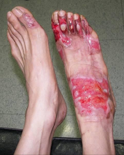 - Jung Sun Pack, et al. Burn-induced acute hepatic disorder in a patient with liver cirrhosis - Figure 2. Superficial second degree scald burns occurred on both feet.